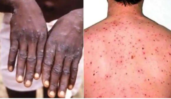 Monkeypox Virus : तेजी से फैल रहा है Monkeypox,जानें कितना खतरनाक है ये वायरस