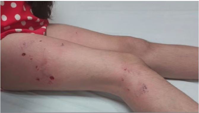 Ghaziabad News : पिटबुल डॉग ने छात्रा पर किया हमला, पैर पर दिखे क्रूरता के निशान
