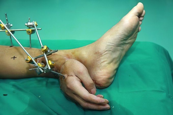 Ajab Gajab News : डॉक्टरों ने कटे हाथ को जिंदा रखने के लिए पहले पैर से जोड़ा, फिर जो काम किया उसकी दुनिया कर रही है तारीफ