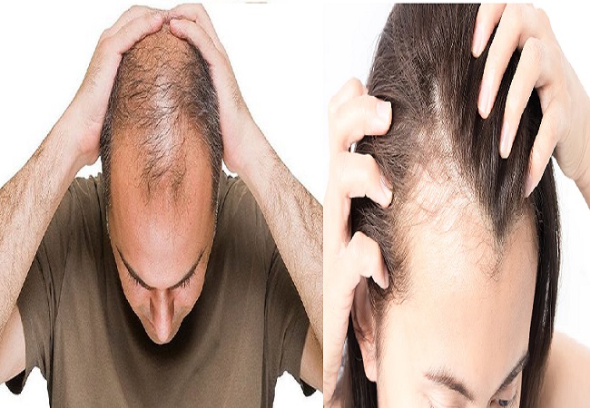 Hair Fall Tips: बाल झड़ रहे हैं तो इस घरेलू उपचार को करें फॉलों, नहीं तो हो जाएंगे गंजेपन का शिकार
