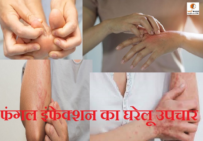 Home Remedies for Fungal Infection