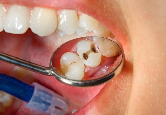 Tooth Worms: दांतों में लग रहे कीड़ों के लिए फॉलों करें ये घरेलू उपचार
