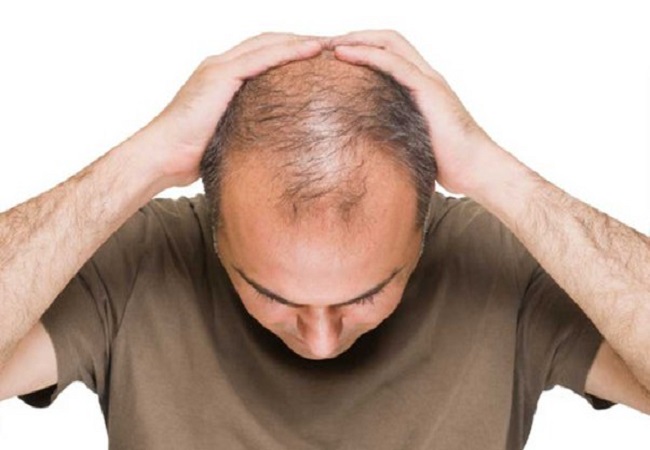 baldness problem