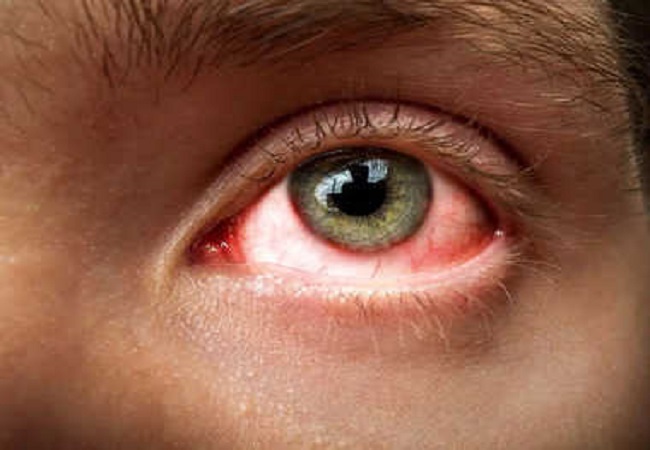 Ayurvedic Treatment of Eye Flu: आई फ्लू या आंखों की जलन और सूजन का ये है आयुर्वेदिक इलाज