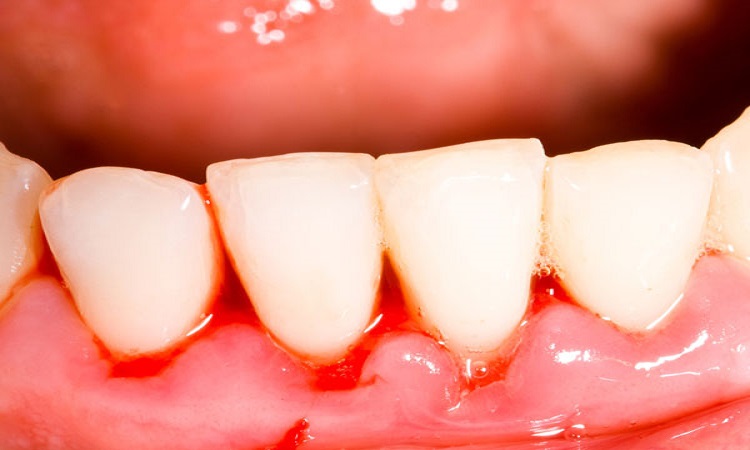 Dental Health: मसूड़ों की इन दिक्कतों को न करें नजरअंदाज, वरना भुगतना पड़ सकता है बड़ा खामियाजा