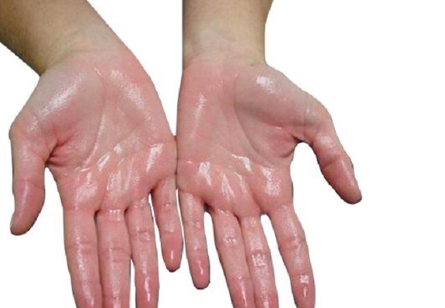 Problem of Excessive Sweating of Palms