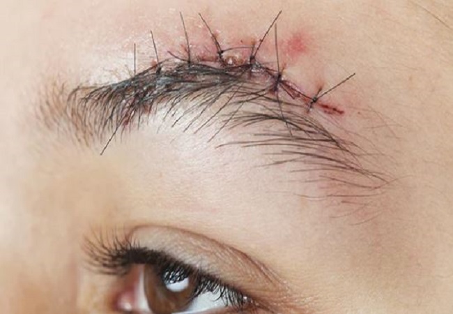 Reduce marks of injury stitches home remedies: चेहरे पर हो या फिर शरीर के किसी भी हिस्से में टांकों के निशान तो इन घरेलू उपाय की मदद से करें गायब