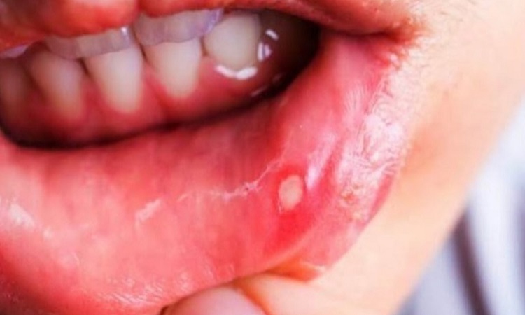 Home Remedies for Mouth Ulcers: अगर आप मुंह के छालों से परेशान हैं तो फॉलों करें ये घरेलू उपचार