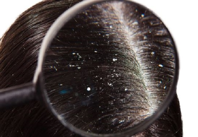 Dandruff Problem: डैंड्रफ छीन न लें आपके बालों की चमक, तुरंत फॉलो करें ये घरेलू टिप्स