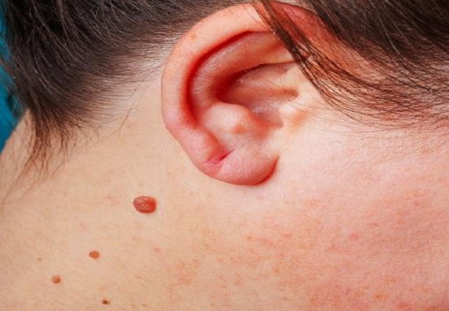 Problem of warts: चेहरे व शरीर के अन्य हिस्सों के मस्सों से हैं परेशान तो ट्राई करें ये घरेलू उपचार