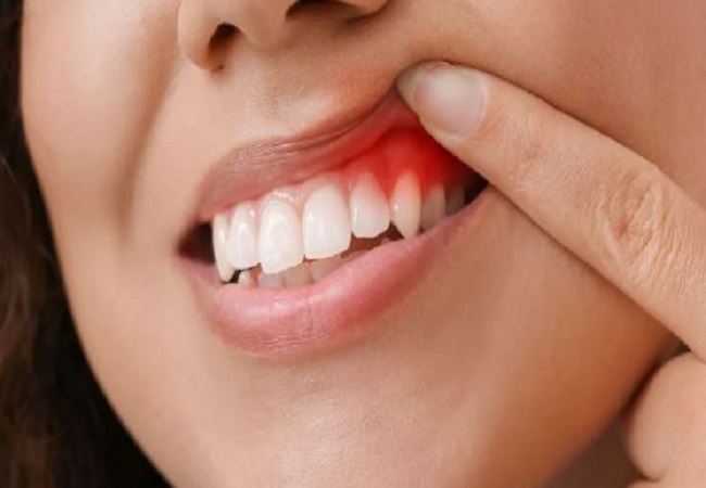 Simple home remedy for bleeding gums