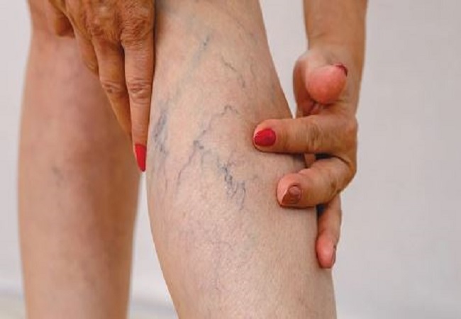 Problem of visible veins in legs: