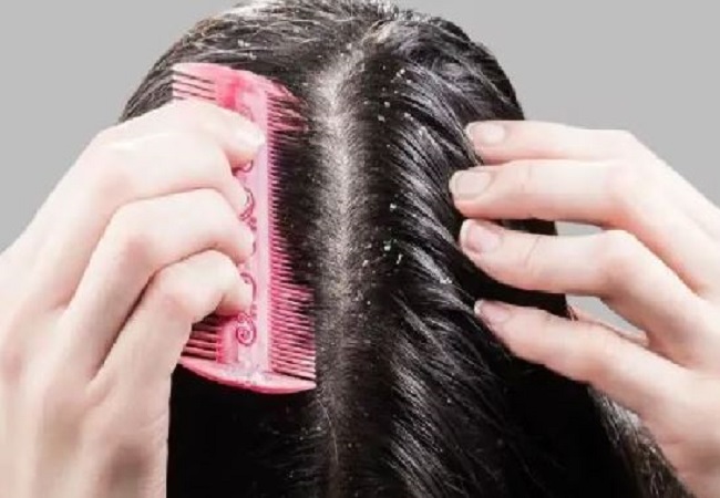 Dandruff Problem: सर्दियों में बालों में हो जाता है डैंड्रफ, तो इन घरेलू उपचार से मिलेगा छुटकारा