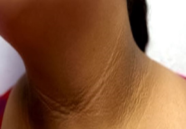 Skin care tips: गर्दन के कालेपन से हैं परेशान तो ट्राई करें ये घरेलू नुस्खें