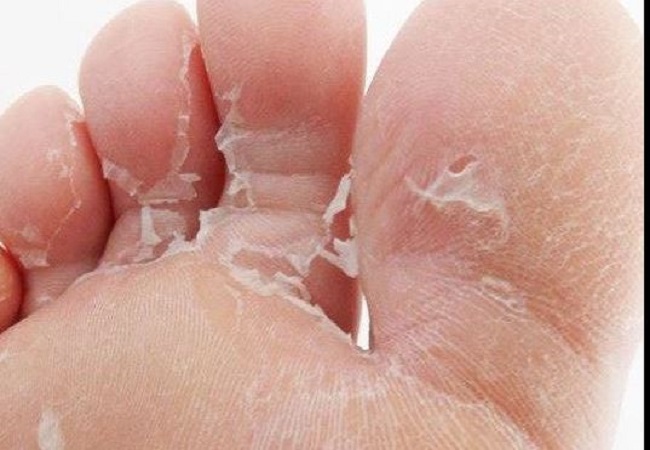 Fungal infection in toes: पानी में अधिक देर तक काम करने से सड़ने लगती हैं पैरों की उंगलियां तो करें ये काम