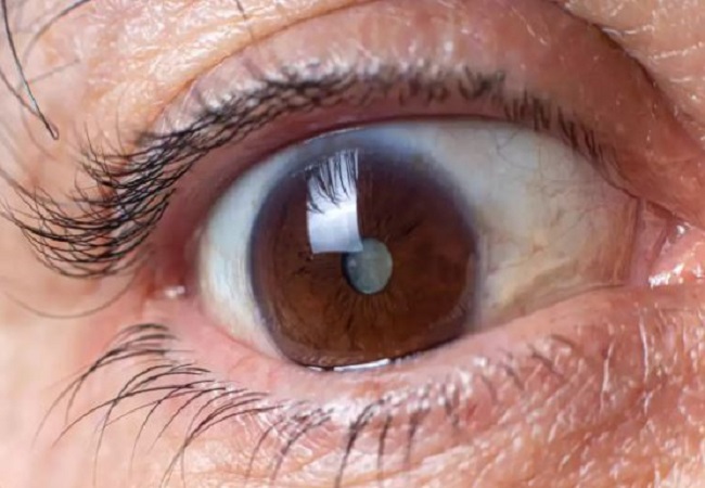 Cataract Problem