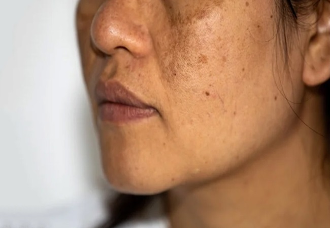 Pigmentation Problem: चेहरे की पिगमेंटेशन प्रॉब्लम से छुटकारा पाने के लिए फॉलो करें ये घरेलू नुस्खें