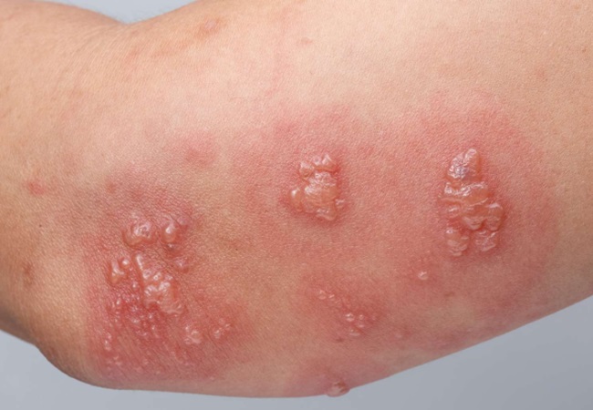 Shingles disease: बुजुर्गों और कमजोर इम्यूनिटी वालों को अपना शिकार बनाता है शिंगल्स, पढ़ें क्या होता है शिंगल्स