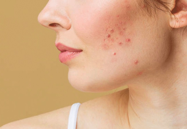 Skin problems: इन घरेलू उपचारों से चेहरे की झाइयों और मुहांसो ही नहीं बल्कि चेचक तक के दाग आसानी से होंगे दूर