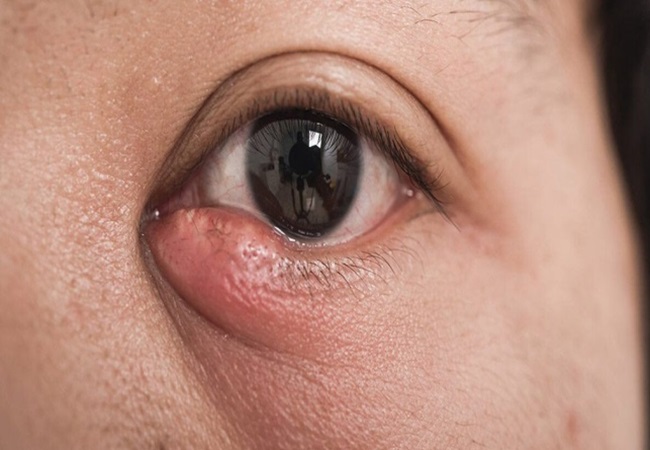Tear duct infection,