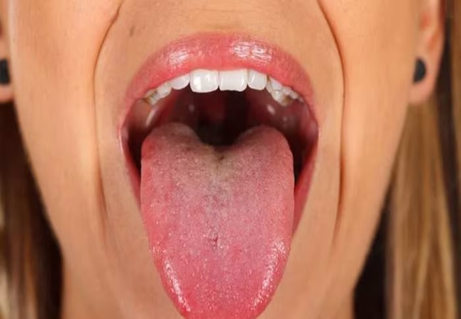 yellow tongue