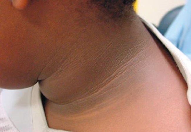 Health Care: गर्दन पर काली लाईनें और कालापन हो सकता है बीमारियों का संकेत