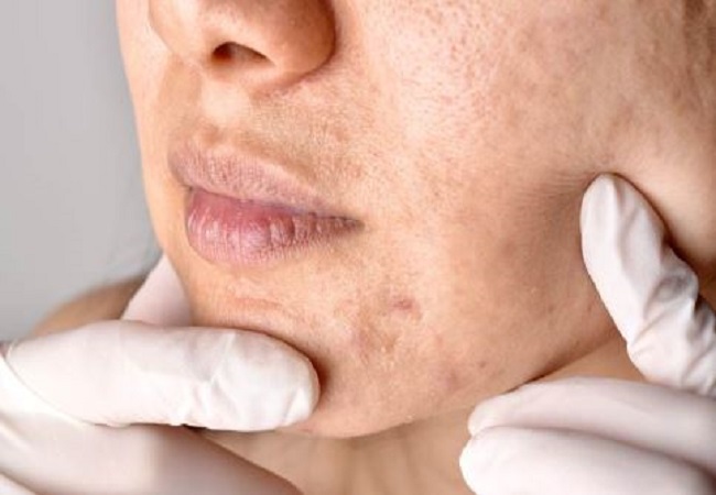 Symptoms of skin cancer: चेहरे की इन समस्याओं की न करें अनदेखी हो सकते हैं स्किन कैंसर के लक्षण