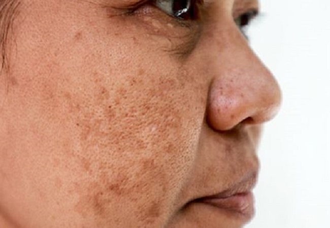 Tips to remove facial shadows: मुलेठी से इस तरह गायब होंगी चेहरे की झाइयां