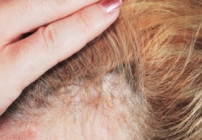 scalp infection