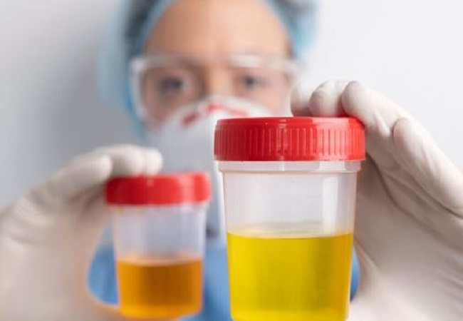 Change in color of urine: पेशाब का बदलता रंग, कहीं शरीर में इस बीमारी का संकेत तो नहीं