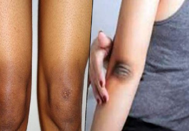 Dark knees and elbows: गर्मियां आते ही घुटने और कोहनियों हो जाती है काली, तो ट्राई करें ये घरेलू उपाय