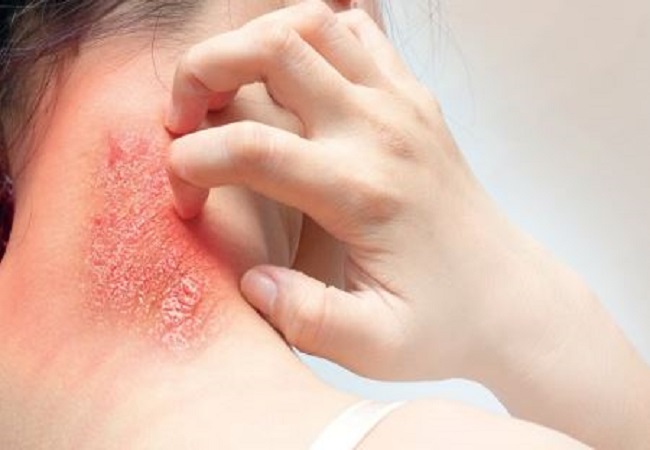 itching, ringworm or skin problems