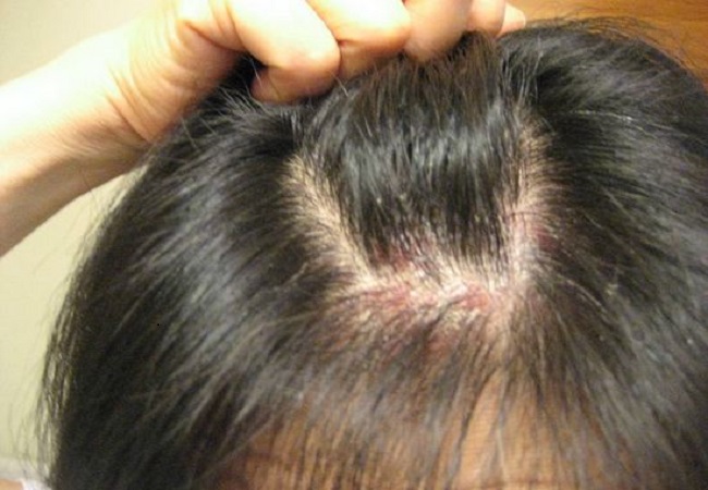 Scalp acne: स्कैल्प एक्ने से हैं परेशान तो ट्राई करें ये घरेलू नुस्खे, जल्द मिलेगा आराम
