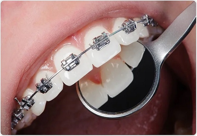 Side effects dental braces: डेंटल ब्रिसेस लगवाने के होते हैं ये साइड इफेक्ट