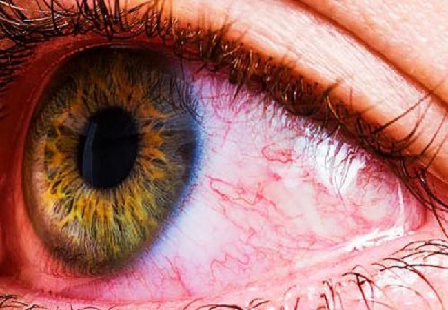 symptoms are visible in the eyes