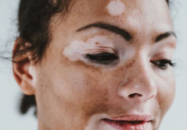 vitiligo problems,