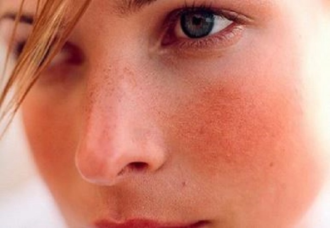 Sensitive skin care: सेंसिटिव स्किन वालोंं को धूप में जाने की वजह से चेहरा हो जाता है लाल, तो इन ब्यूटी टिप्स को करें फॉलो