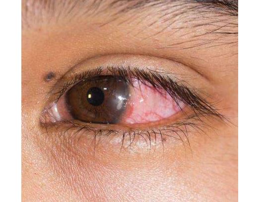 Eye Infections Avoiding : गर्मियों में भी हो सकता है आई फ्लू  , जानें बचाव के टिप्स