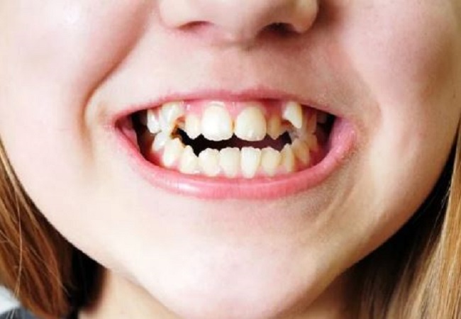 टेढ़े मेढ़े दांतो से हैं परेशान तो इन तरीको से कर सकते है सही
