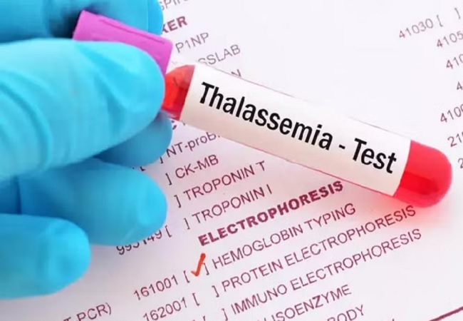 World Thalassemia Day: क्या होती है थैलेसीमिया बीमारी, इसके लक्षण और इलाज