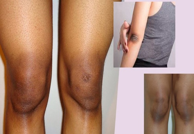 blackness on elbows, knees and underarms