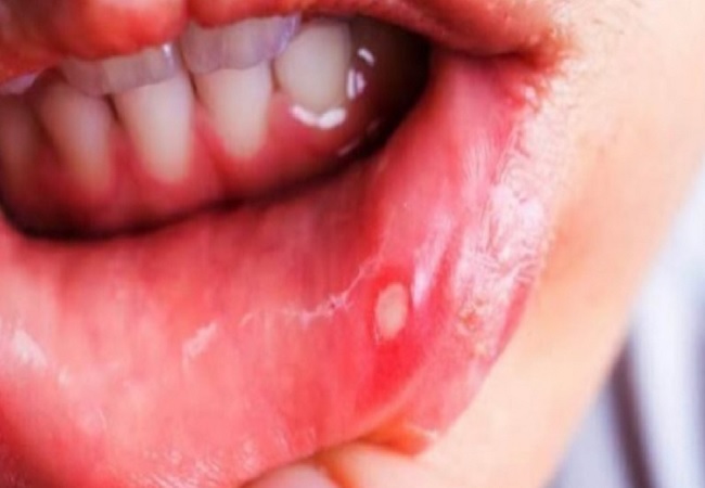 Problem of mouth ulcers: जीभ और मुंह के छालों से छुटकारा पाने के लिए अपनाएं ये घरेलू उपचार, तुरंत मिलेगी आराम
