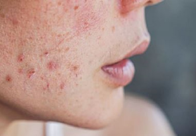 Acne and Pimples