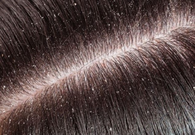 Dandruff Problems: गर्मियों में बालों में डैंड्रफ से है परेशान तो इन चीजों से मिलेगा छुटकारा