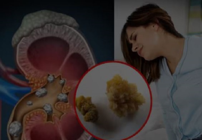 Kidney stones: किडनी में पथरी होने पर इन चीजों का सेवन करने से जल्दी घुल जाता है स्टोन