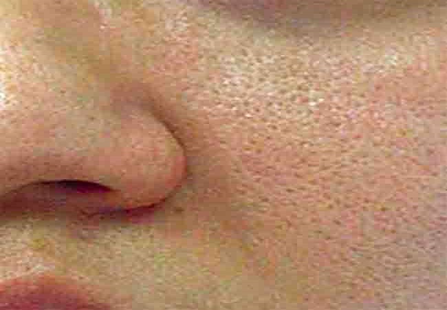 Open Pores Problem: ओपन पोर्स चेहरे की बिगाड़ रहे हैं खूबसूरती, तो इन टिप्स को फॉलो करके पाएं छुटकारा