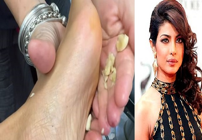 Priyanka Chopra applies garlic on the soles of her feet