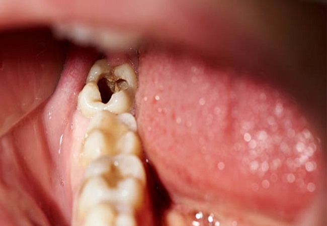 Remedy for toothache: दांतों में लगे कीड़ों और पीलेपन से परेशान हैं तो बस इस छोटे से उपाय से मिलेगा छुटकारा