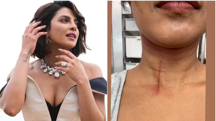 Priyanka Chopra Injury: द ब्लफ के सेट पर स्टंट करते हुए लगी भयानक चोट, तस्वीर शेयर कर बताया हाल