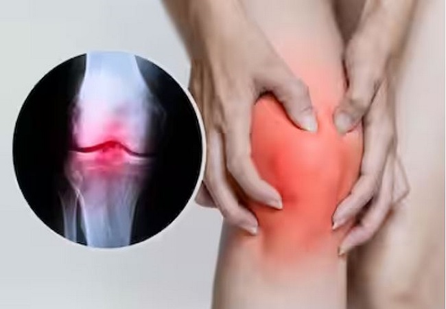 Arthritis: गठिया के दर्द या अर्थराइटिस से परेशान हैं तो इन नेचुरल तरीकों से पाएं राहत